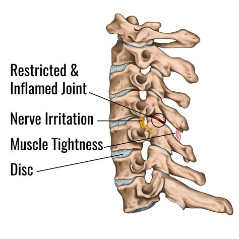 Cervical Joint Restriction Causes Neck Pain Mind Body Chiropractic