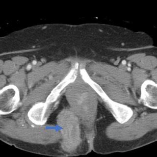 Preoperative CT Demonstrating Pararectal Hernia Blue Arrow