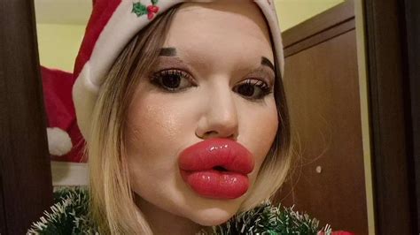 Woman With World S Biggest Lips Treats Herself To More Filler As A