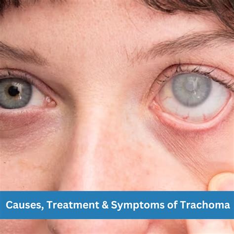 Causes, Treatment & Symptoms of Trachoma