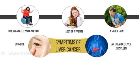 Liver Cancer Types Causes Symptoms Diagnosis Treatment Prevention Progosis