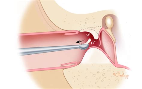 Exostoses of the Ear Canal – Oto Surgery Atlas