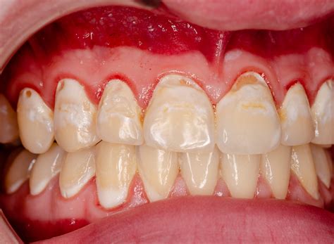Tooth Remineralization - Beacon Hill Dental Centre