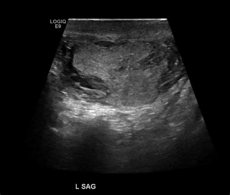 Ultrasound Demonstrating Testicular Rupture Violation Of Tunica