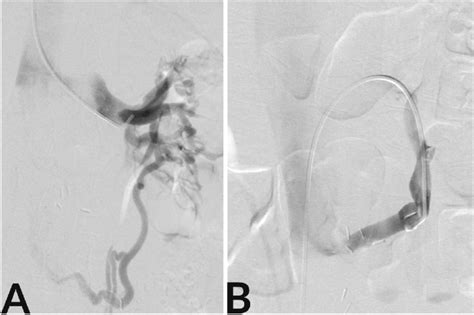 Gonadal Vein Transposition Venogram Imaging Description A Venogram