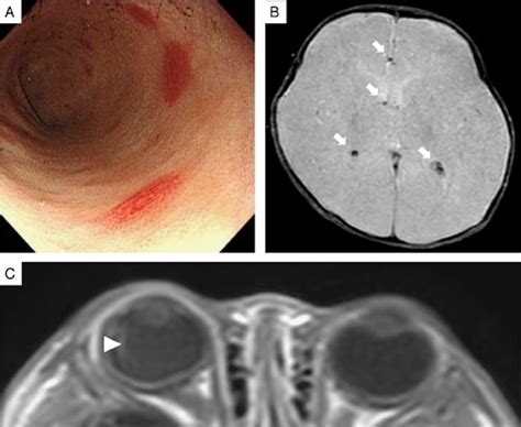 A Colonoscopic Image Showing Multiple Erythematous Lesions B And C Download Scientific