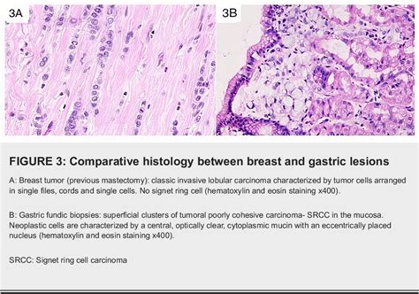 Figure 3 From Gastric Signet Ring Cell Carcinoma Metastasis From