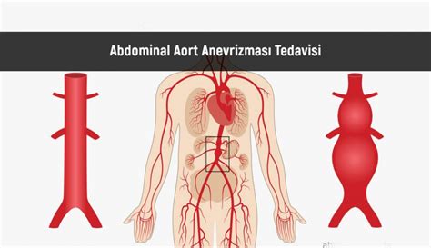 Abdominal Aort Anevrizmas Nedenleri Ve Tedavisi Tedavi Tc