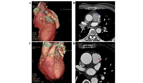 Dualsource CT Coronary Angiographic Evaluation Of Coronary Artery Fistulas