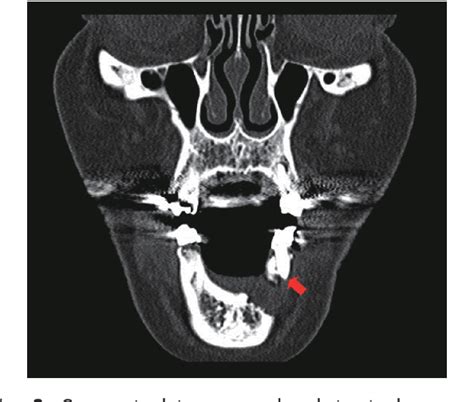 Figure 3 from Anterior stafne bone cyst mimicking periapical cyst: a ...