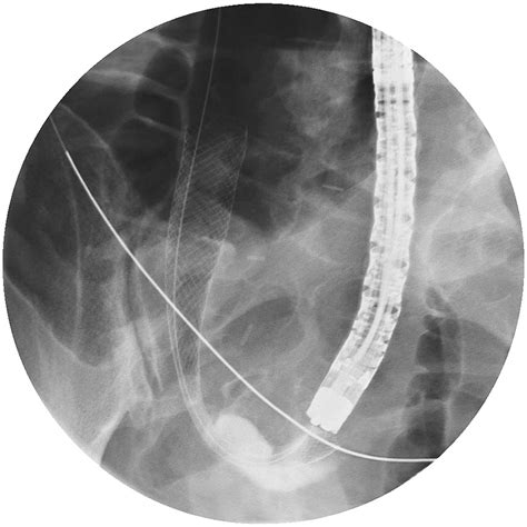 Stenting Of The Proximal Colon In Patients With Malignant Large Bowel