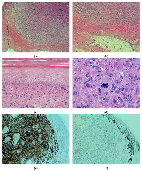 Histopathologic Evaluation Of Atypical Fibroxanthoma Or Pleomorphic