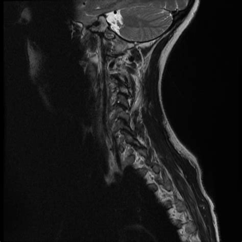 Clival And Olfactory Groove Meningiomas Radiology Case Radiopaedia