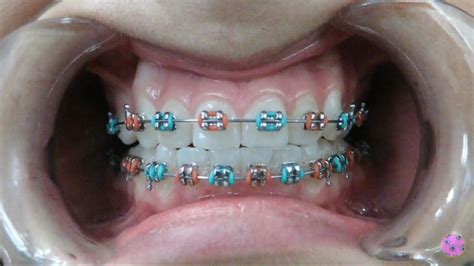 √ Braces Color Teal