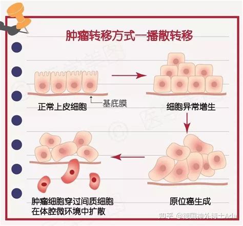 《nature》：首张“癌症转移图谱”问世！揭秘人体癌细胞转移规律，癌细胞最容易转移至哪些部位？ 知乎