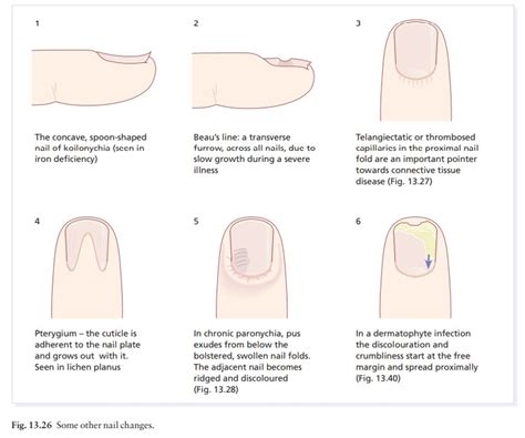 Nail Fold Infarcts Full Article Optimal Diagnosis And Management Of