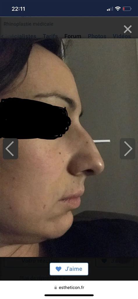 Rhinoplastie M Dicale Possible Rhinoplastie M Dicale Ou Correction