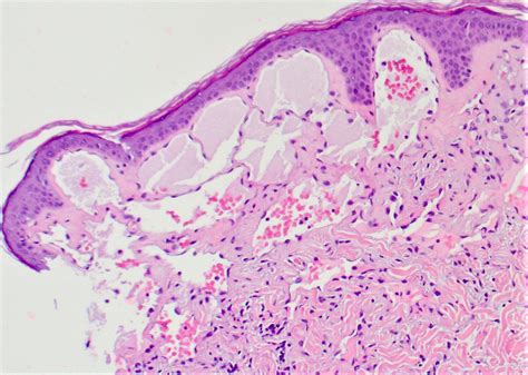 Lymphangioma Histology