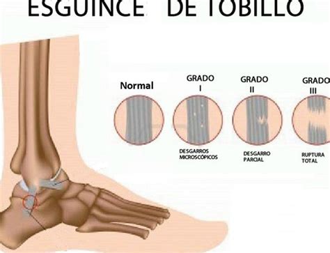 Cuánto tiempo tarda en curarse un esguince de tobillo Guía completa