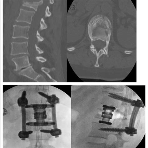 Patient Y with L1 burst fracture who underwent lateral L1 corpectomy ...