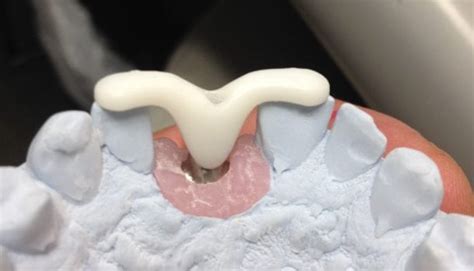 Implant Abutment Placement Jig3 Robertson Dental Lab