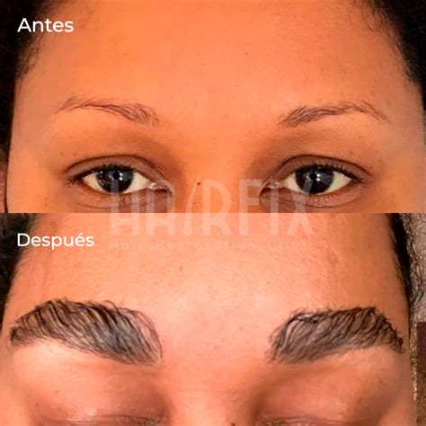 Injerto de Cejas en México Información y procedimiento