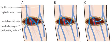 Brachiocephalic Fistula Anatomy