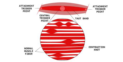 Calf Muscle Knots - All You Need to Know About These Painful Lumps! – Born Tough