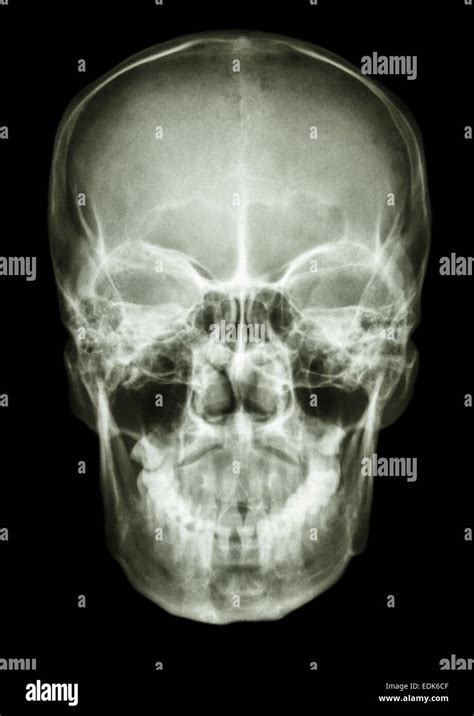 film x-ray skull AP : show normal human's skull Stock Photo: 77254143 - Alamy