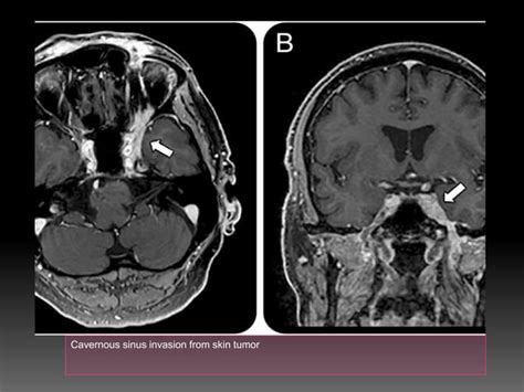 Cranial Nerve Palsy Mri