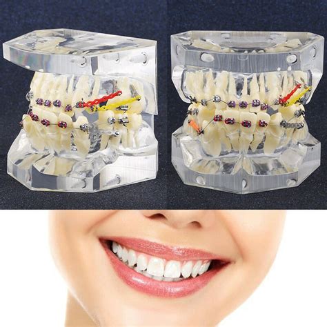 Dental Orthodontic Treatment Malocclusion Model With Metal Brackets