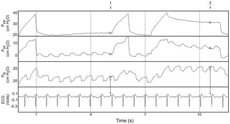 Transpulmonary Pressure And Gas Exchange During Decremental PEEP