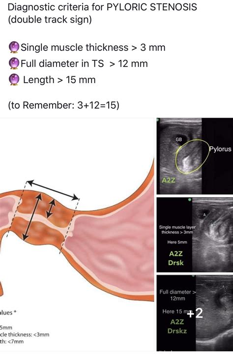 Abdominal Ultrasound Made Easy Step By Step Guide Artofit