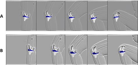 Figure 2 From Comparison Of In Vivo Kinematics Of Total Knee