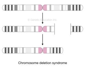 What Is Deletion Syndrome Top Chromosomal Deletion Syndromes