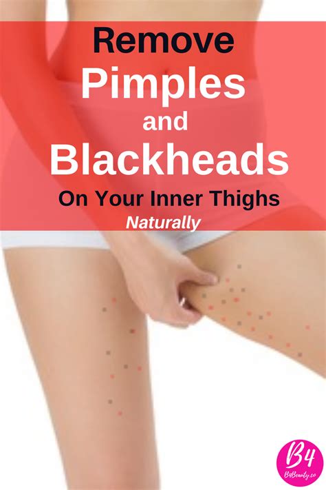 Pimples And Blackheads Inner Thighs Pictures Get Rid Of Them Inner