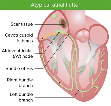 Atrial Flutter Concise Medical Knowledge