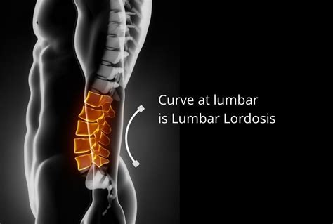 Fix Straightening Of Lumbar Lordosis With 5 Top Exercises Physiosunit