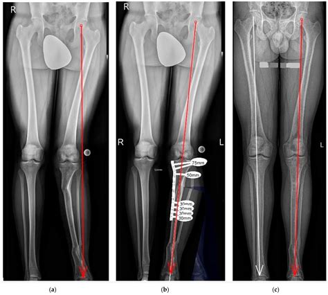Corrective Osteotomies in Severe Non-Idiopathic Lower Limb Alignment