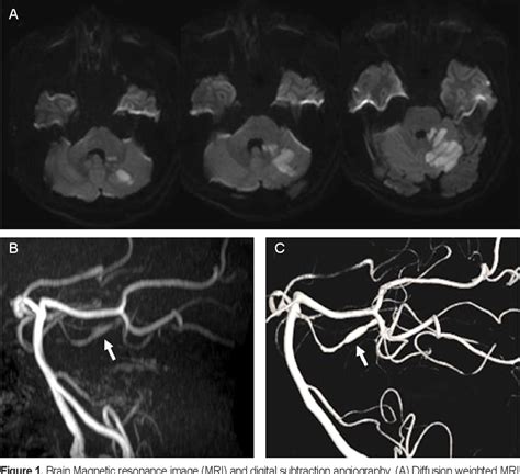 Figure 1 From Acute Cerebellar Infarction Caused By Superior Cerebellar