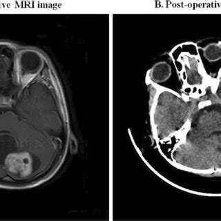 Pre Operative Mri And Post Operative Ct Images Of A Selected Case Of