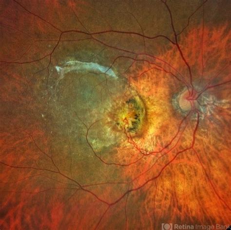 Retinal Angiomatous Proliferation Rap What Is It