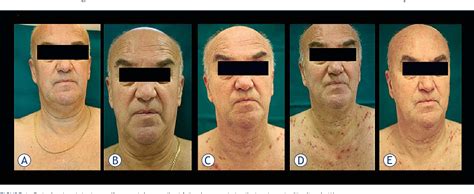 Figure 1 from Management of cetuximab-induced skin toxicity with the ...