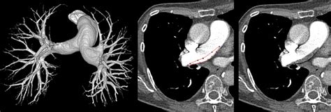 Diagnostic Accuracy Of Pulmonary Ct Angiography At Low Tube Voltage