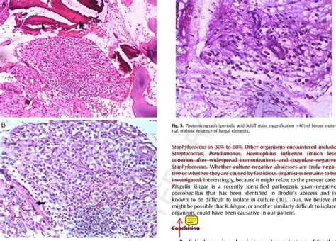 Photomicrographs Showing Dense Infiltrate Of Chronic Inflammatory Cells