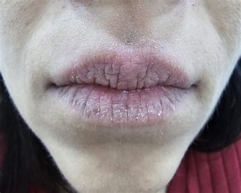Labios Ressecados E Rachados O Que Pode Ser - Queilite: quando lábios ressecados e rachados escondem um problema maior