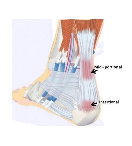 Achilles Heel Injury Treatments - Pro Chiro