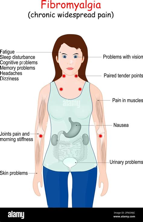 Que Es Fibromialgia Y Tratamiento