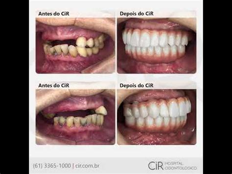 Antes e Depois Reabilitação Funcional e Estética Implantes