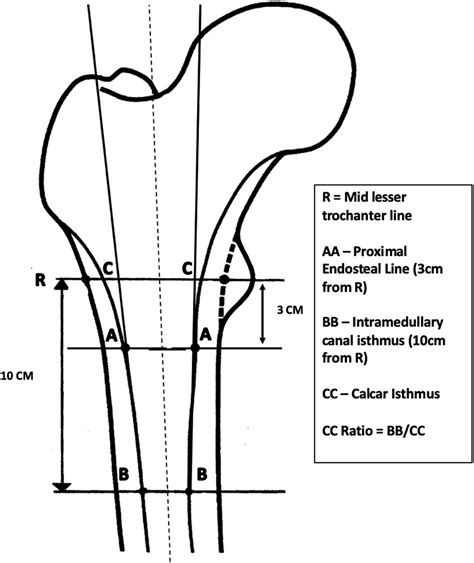 The Relationship Between Canal Diameter And The Dorr Classification